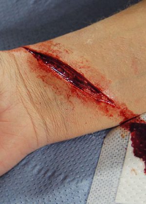 Cut Wrist Prosthetic