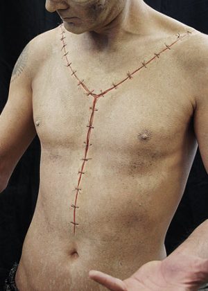 autopsy scar prosthetic