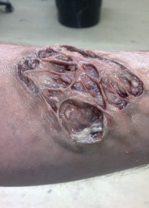 Infected Wound Prosthetic